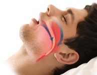 Sleep Apnea.png